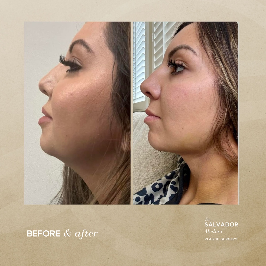 Thank you Dr. MEDINA! Michigan hit 80 today and it is my first outing with my new skinny arms in the t shirt! Also looking all refreshed with my fully healed lids. - 11 Before and After, Dr. Salvador Medina, plastic surgeon Tijuana