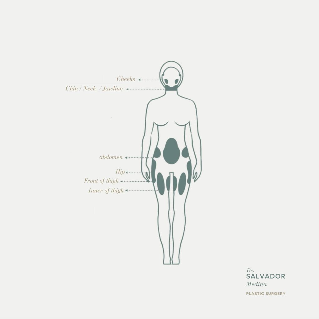 Liposuction Areas