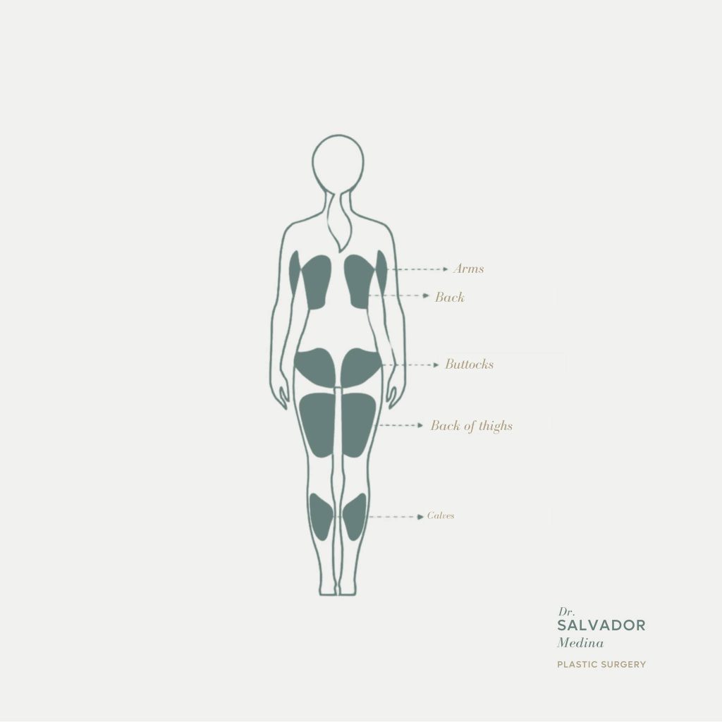 Liposuction Areas