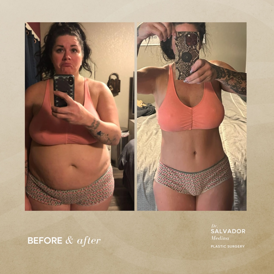 Thank you Dr. MEDINA! Michigan hit 80 today and it is my first outing with my new skinny arms in the t shirt! Also looking all refreshed with my fully healed lids. - 5 Before and After, Dr. Salvador Medina, plastic surgeon Tijuana