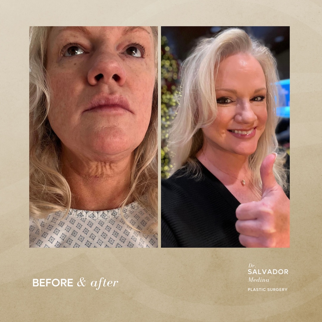 Thank you Dr. MEDINA! Michigan hit 80 today and it is my first outing with my new skinny arms in the t shirt! Also looking all refreshed with my fully healed lids. - 9 Before and After, Dr. Salvador Medina, plastic surgeon Tijuana