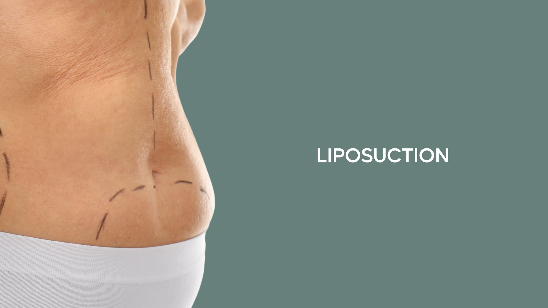 Liposuction Surgery in Tijuana, Dr. Salvador Medina, certified specialist surgeon