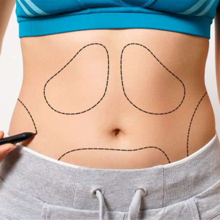 Body Contouring Procedure