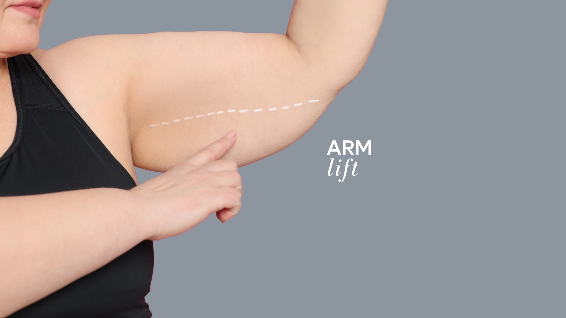 Arm Lift Surgery