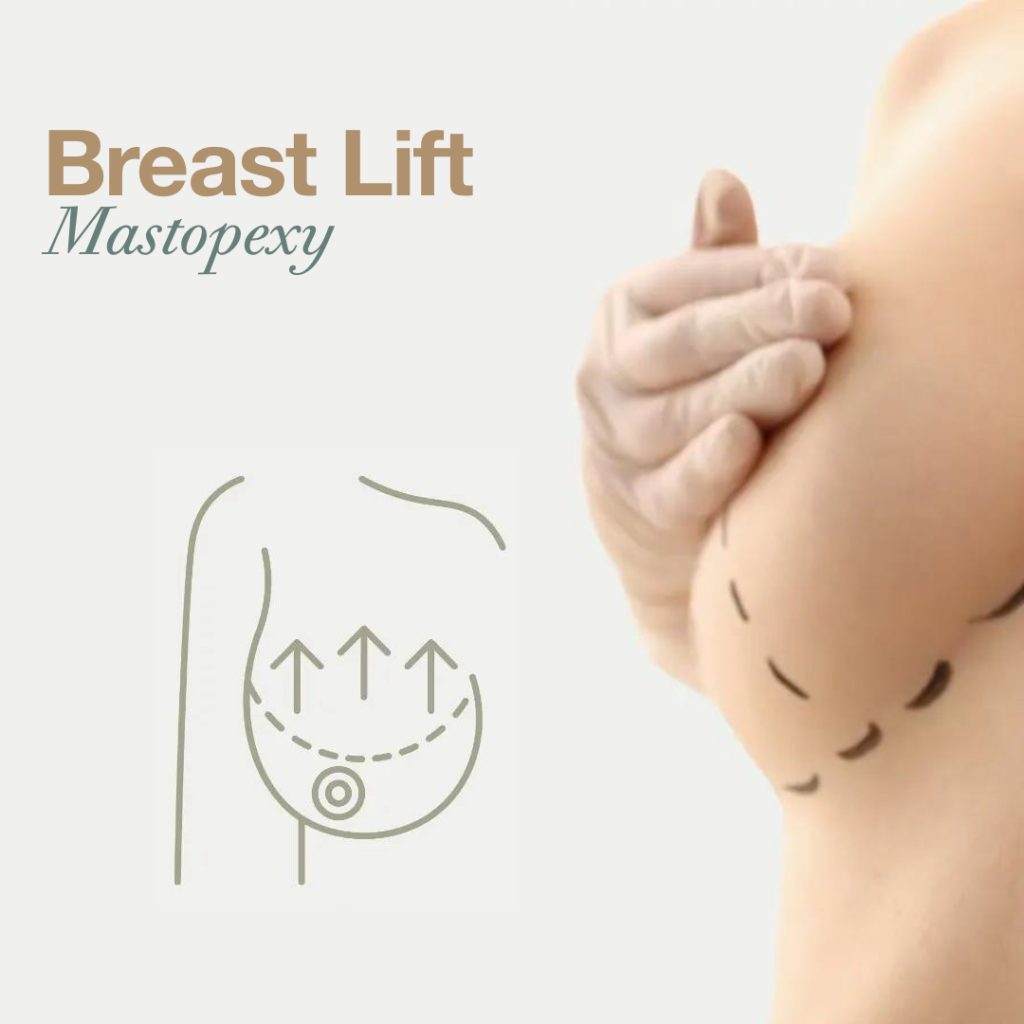 Is a Breast Lift Right or Mastopexy for You? 