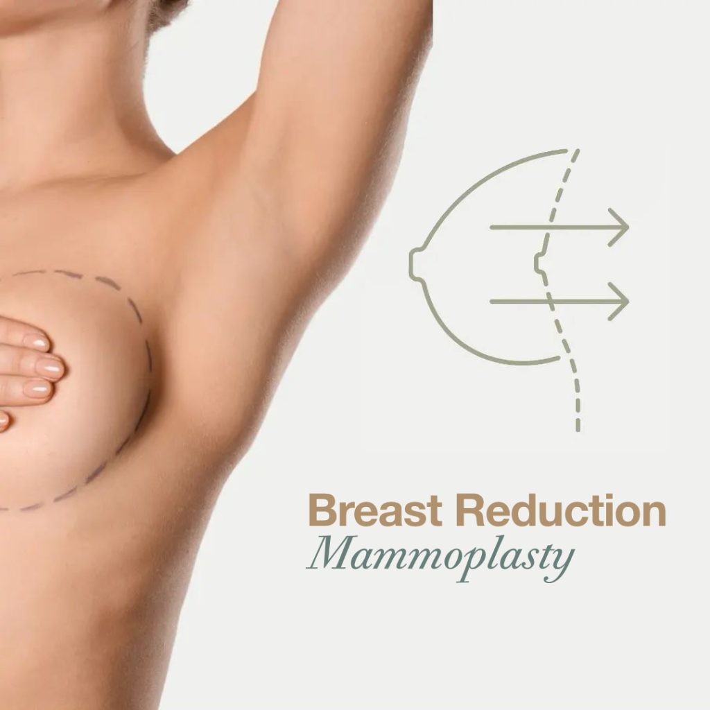 Breast Reduction or Mammoplasty