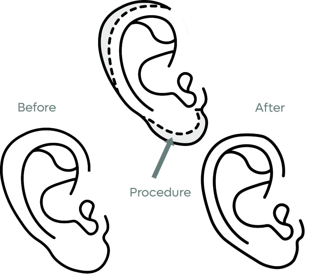 Otoplasty, Tijuana Plastic Surgery. 
Dr.Salvaor Medina