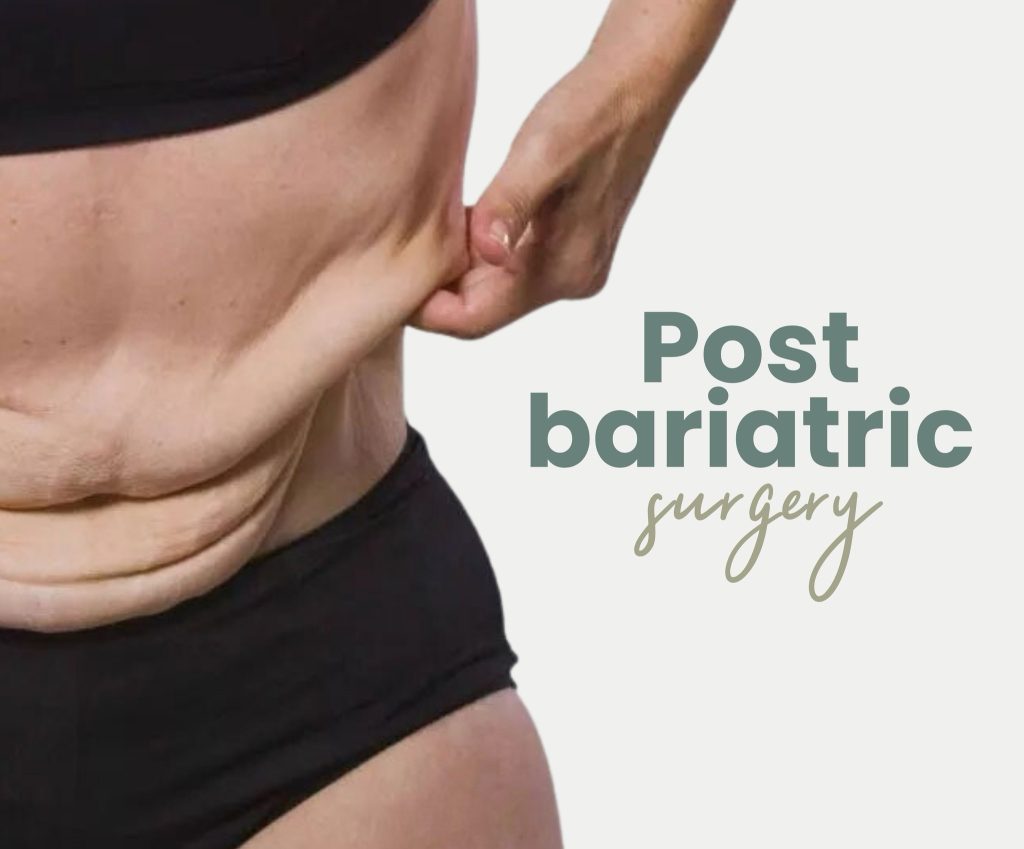 Post-bariatric surgery