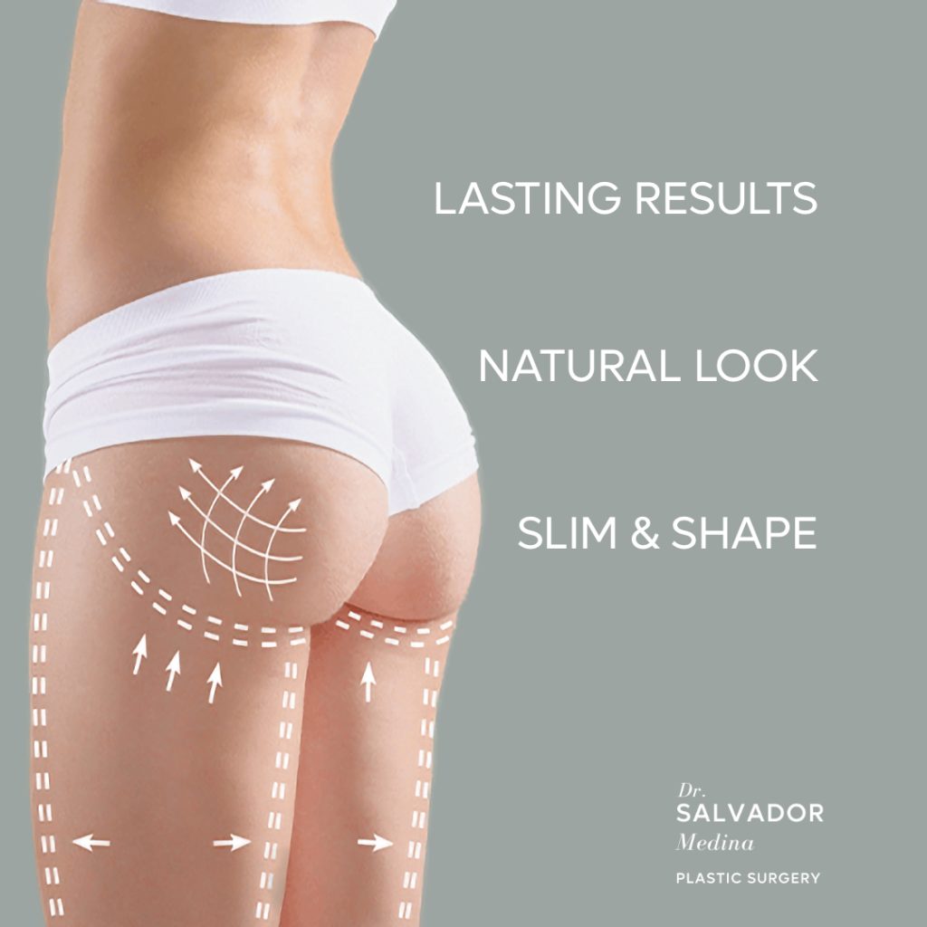 Brazilian Butt Lift, Dr. Salvador Medina, plastic surgeon tijuana