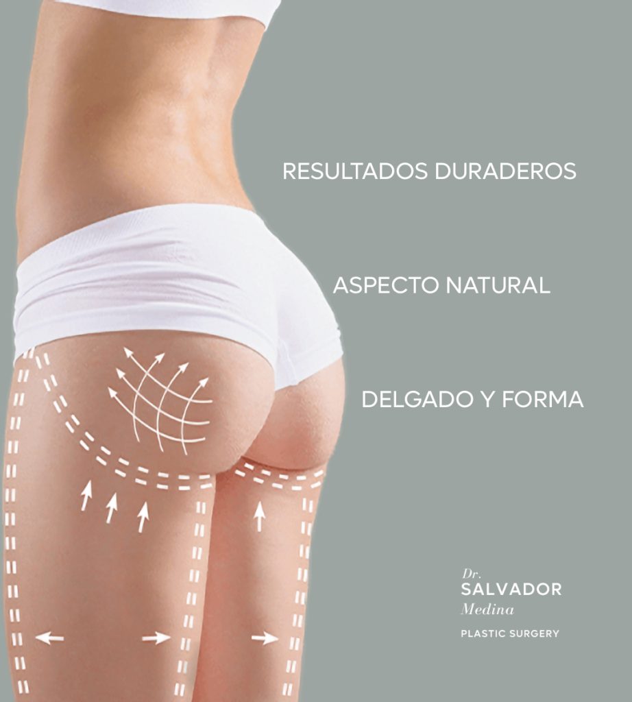 Levantamiento de glúteos brasileño