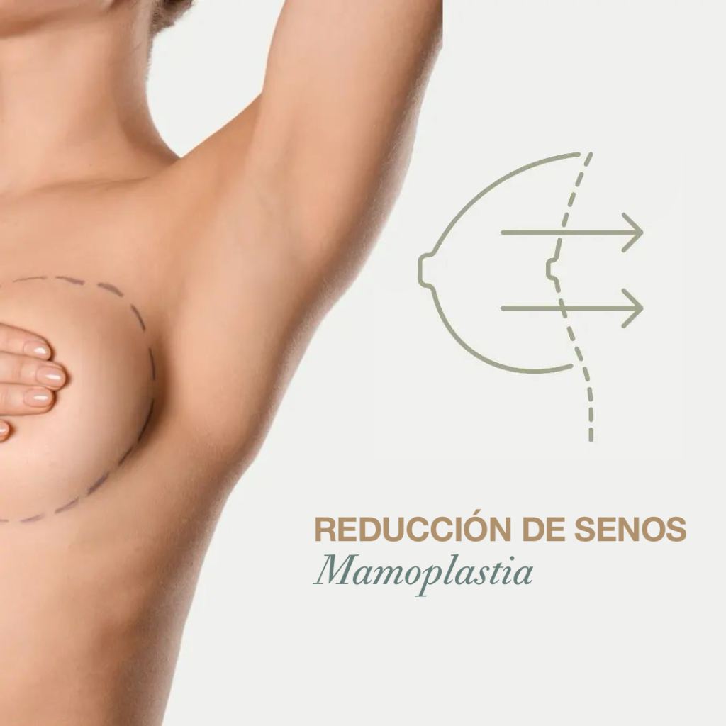 Reducción de Senos o Mamoplastia