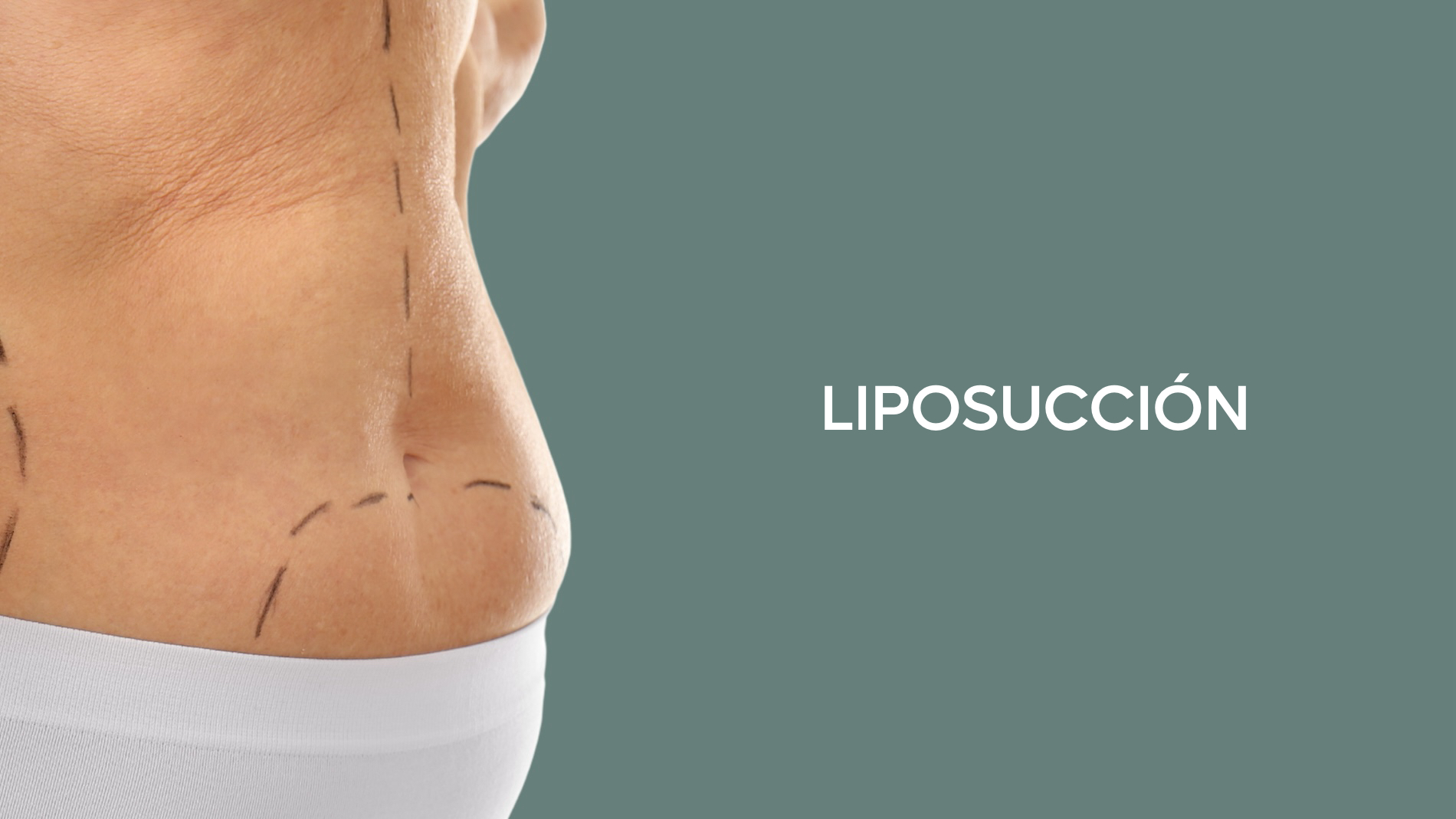 Cirugía de Liposucción en Tijuana, Dr. Salvador Medina, cirujano especialista certificado