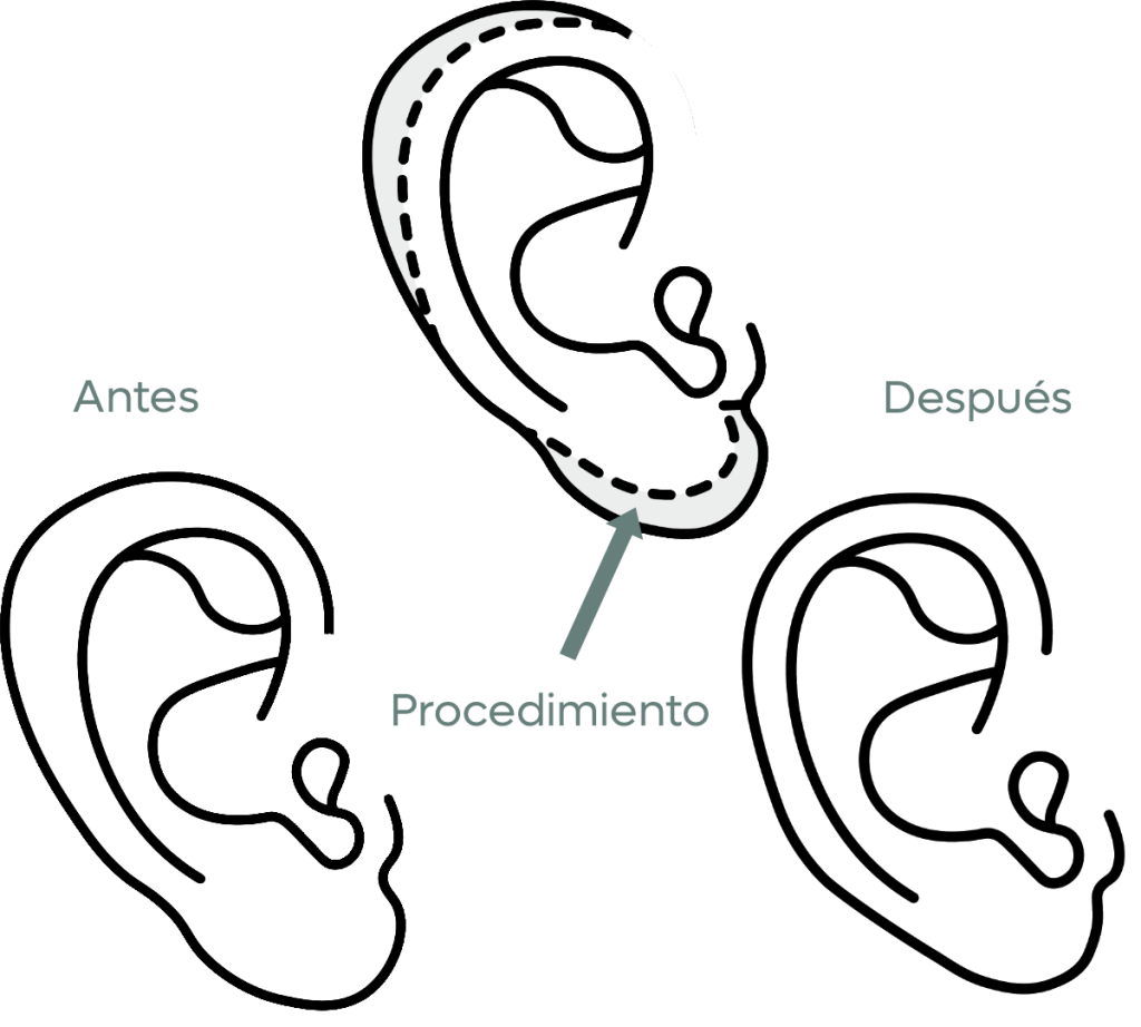 Otoplastia, Cirugía Plástica Tijuana.
Dr. Salvador Medina