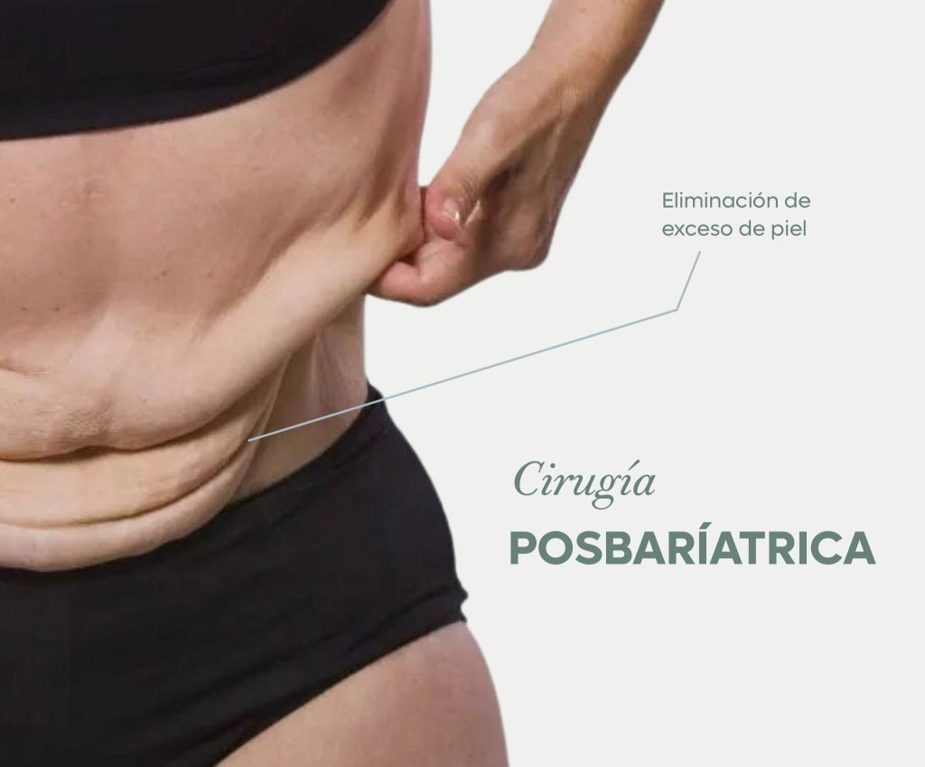 Eliminación de exceso de piel, Cirugía posbariátrica
