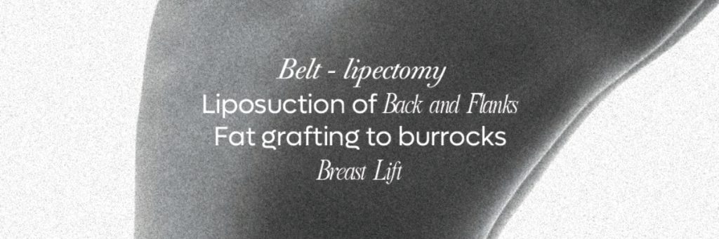 Life-Changing Lower Body Lift in Tijuana / Belt Lipectomy