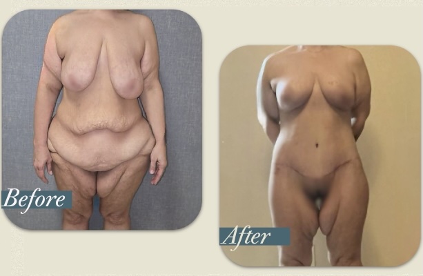 Life-Changing Lower Body Lift in Tijuana / Belt Lipectomy
